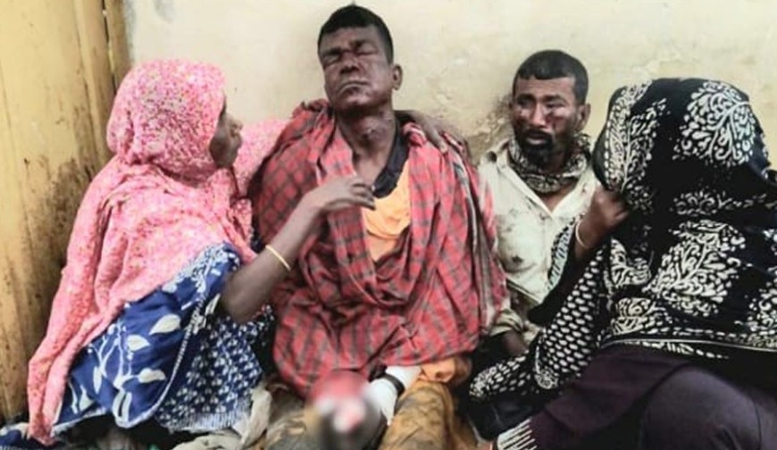 মাটি কাটতে গিয়ে বিস্ফোরণ: শার্শায় পরিত্যক্ত বোমায় দুই শ্রমিক গুরুতর